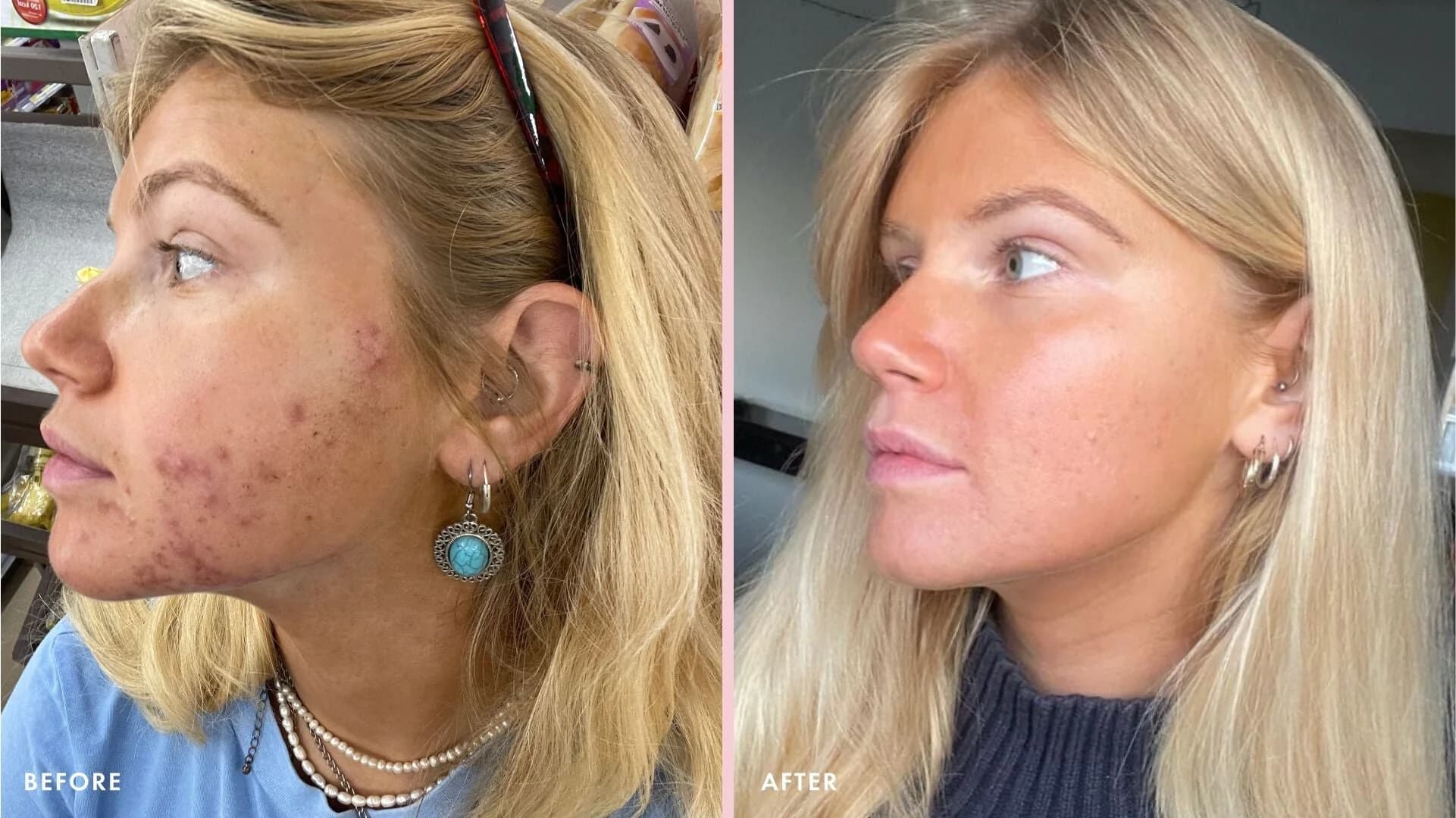 Natural Remedies for Hormonal Acne: Evidence-Based Solutions & What to Avoid