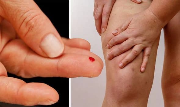 Insulin Resistance and Acne: How Blood Sugar Impacts Your Skin