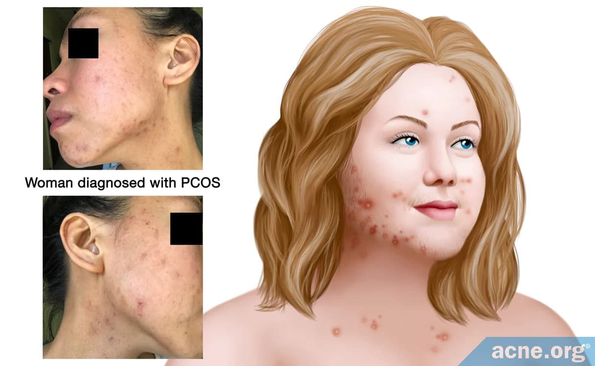 PCOS and Acne: Understanding the Hormonal Link