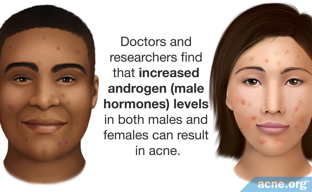 Androgen Levels and Acne: Natural Ways to Balance Your Hormones